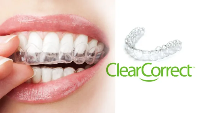 clear correct aligner being placed into a mouth