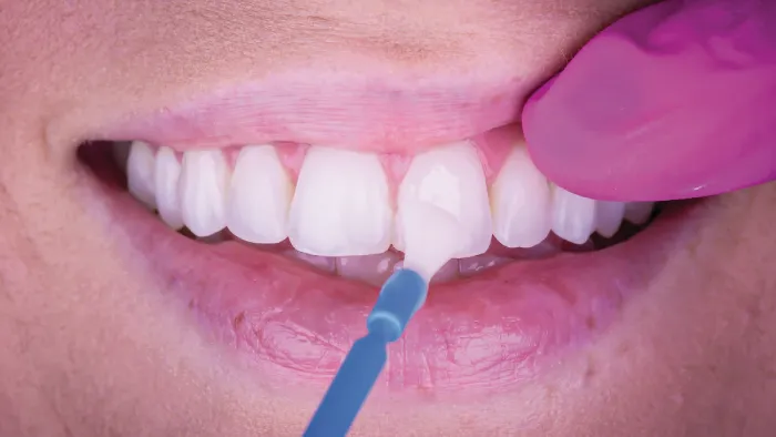 fluoride treatment being applied with a brush to teeth