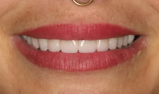 a perfect smile after full mouth rehabilitation